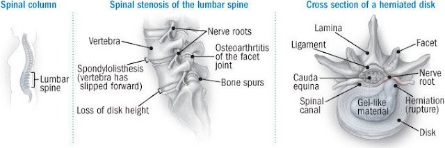 Herniated Disks Causes Symptoms and Treatment Options