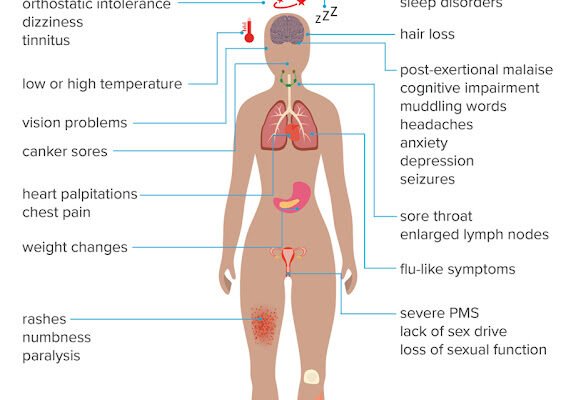 Chronic Fatigue Syndrome