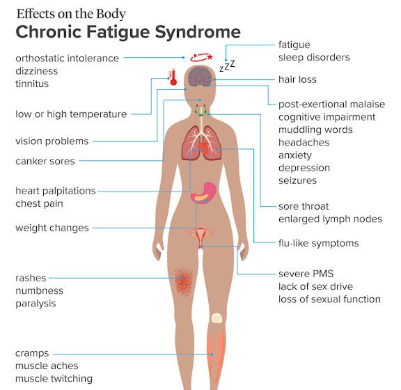 Chronic Fatigue Syndrome